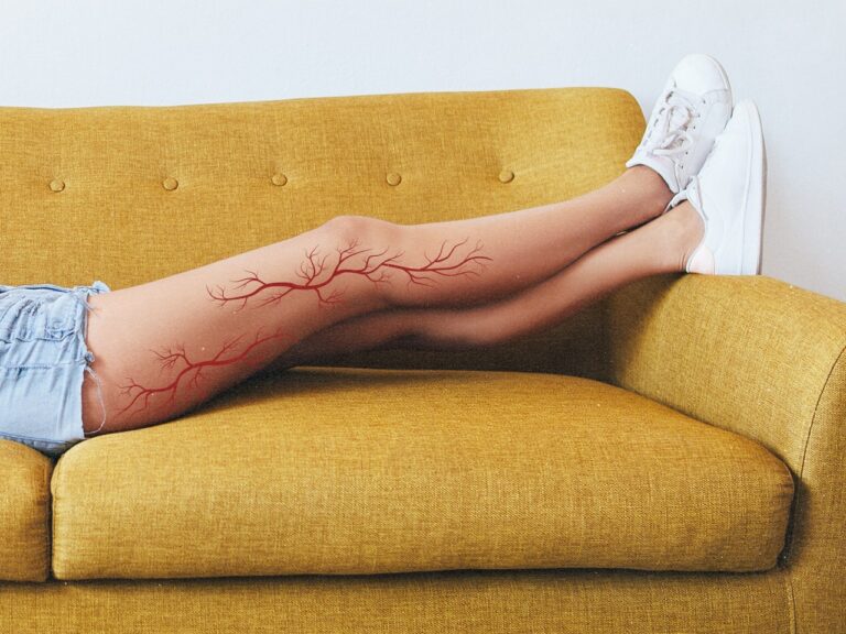 Spider webs to cure: Varicose veins treatments
