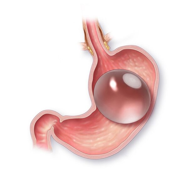 Gastric Balloon: Your Comprehensive Guide